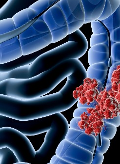 Nivolumab Plus Chemotherapy ‘Potential New Standard of Care’ for Patients With Advanced, Metastatic Gastric Cancers