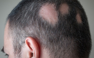 Patients with Alopecia Areata Show Increased Rates of Distressed Personality, Depression, Anxiety